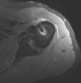 Figure 2 for case Tear of tendon of long head of biceps brachii sp tenodesis (RID1944)